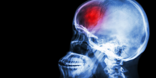 Under-representation for Women in stroke trials for 30 years